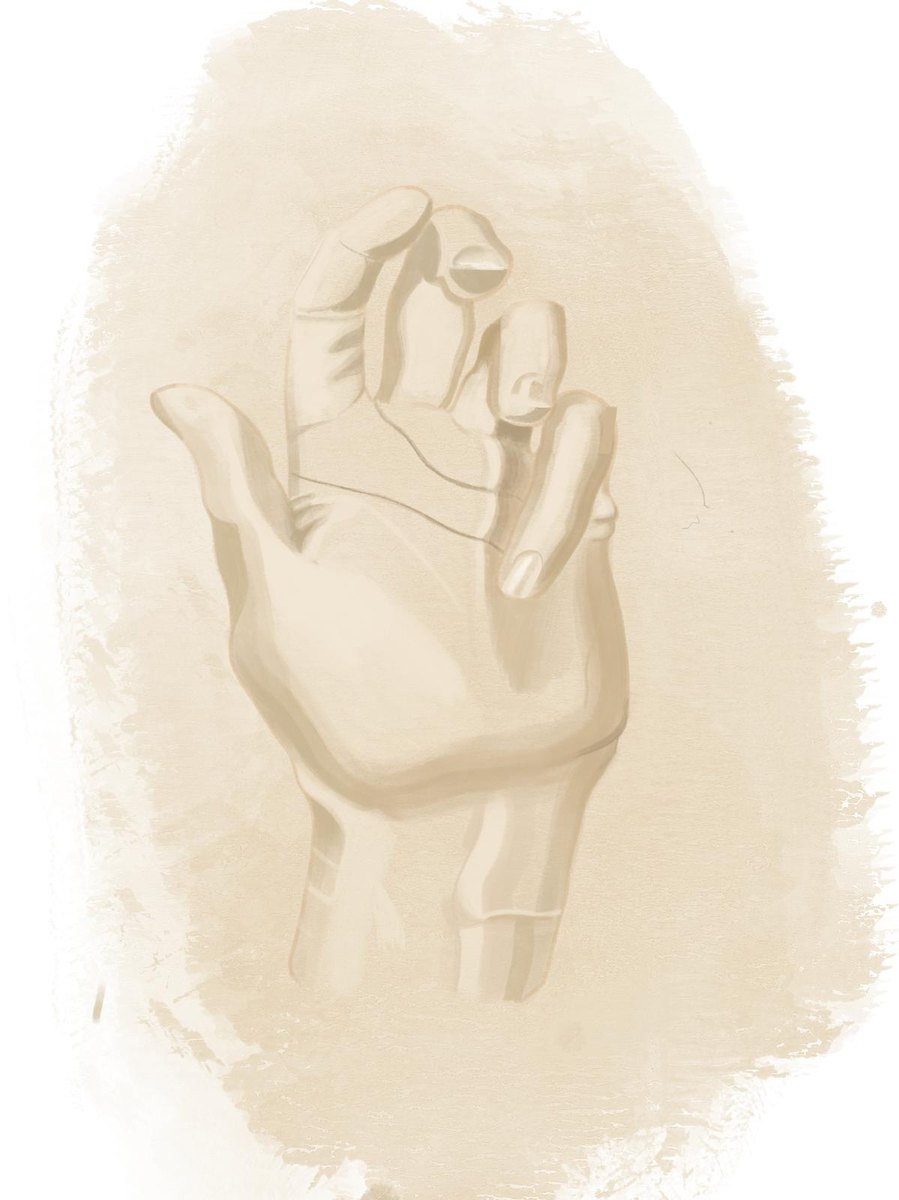 Illustration of a hand affected by Dupuytren's contracture, with the ring and little fingers drawn into the palm