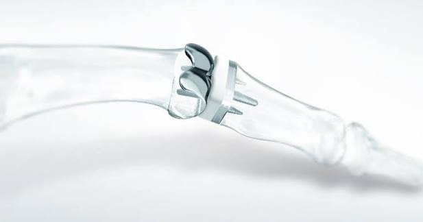 Capflex PIP finger joint replacement implant