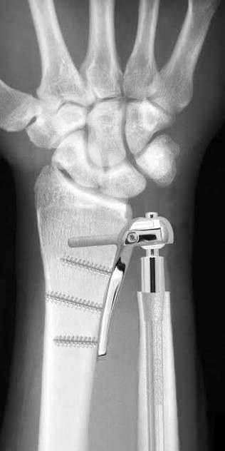 Scheker distal radioulnar joint replacement shown on a wrist radiograph